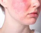 Skóra policzków zaczerwieniona, widoczne drobne naczynka, czyli teleangiektazje.