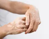 Dłonie z widocznymi, nieregularnymi plamami depigmentacji, charakterystycznymi dla bielactwa nabytego.