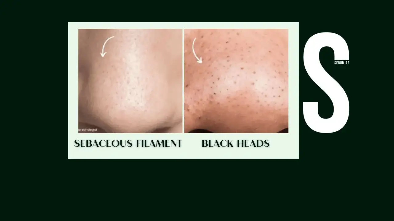 Porównanie skóry przed i po: widoczne pory z naskórkiem (sebaceous filament) i czarne kropki (black heads). Wyciskanie wągrów może pomóc.