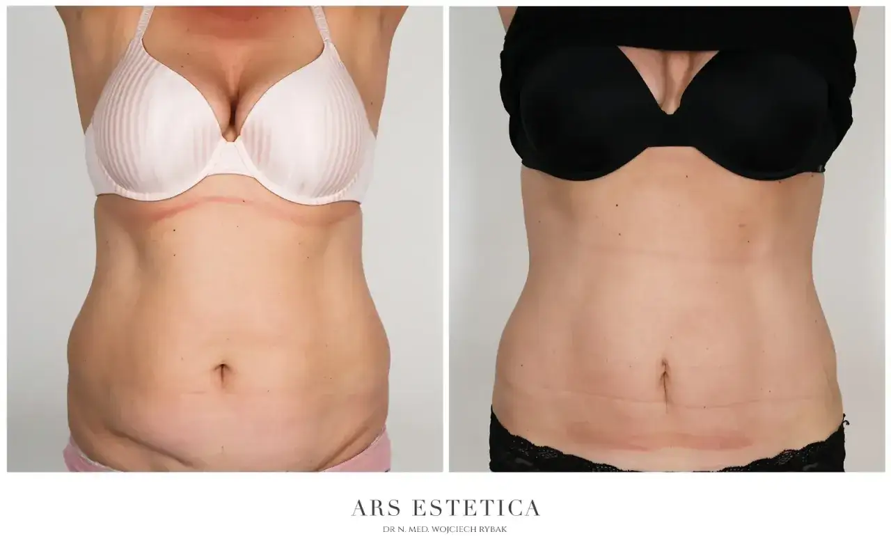 Liposukcja definicja modelowanie sylwetki